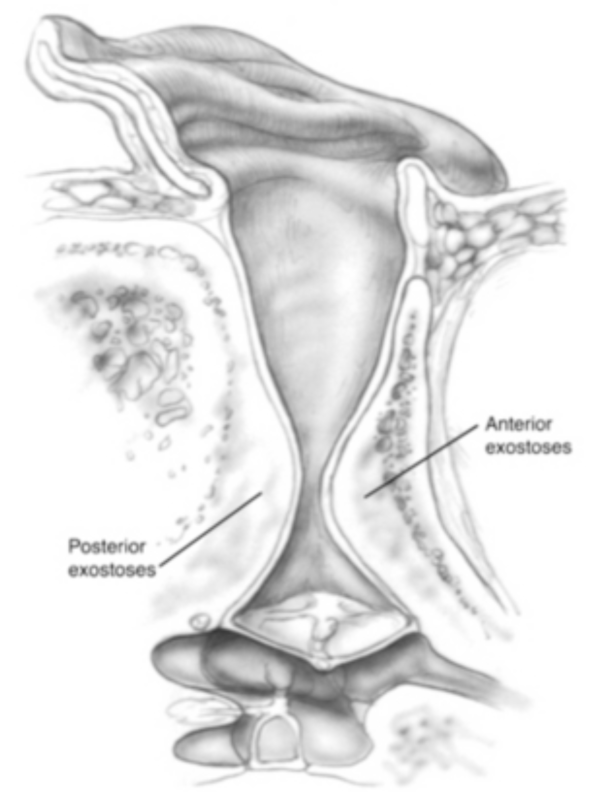 Exostosis and Canalplasty